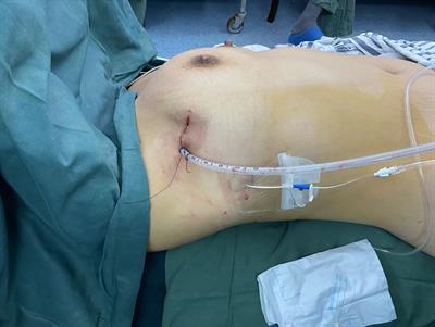 Neoadjuvant radiotherapy plus single-incision thoracoscopic surgery in the treatment of type B3 thymomas
